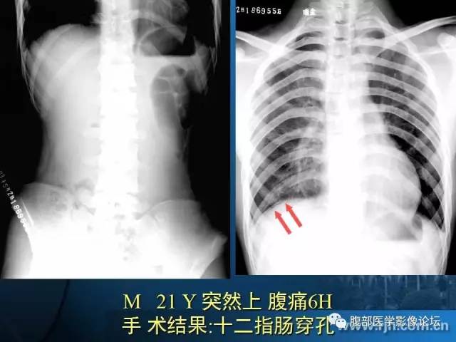 【PPT】 急腹症时的腹腔积气与积液