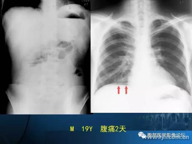 【PPT】 急腹症时的腹腔积气与积液