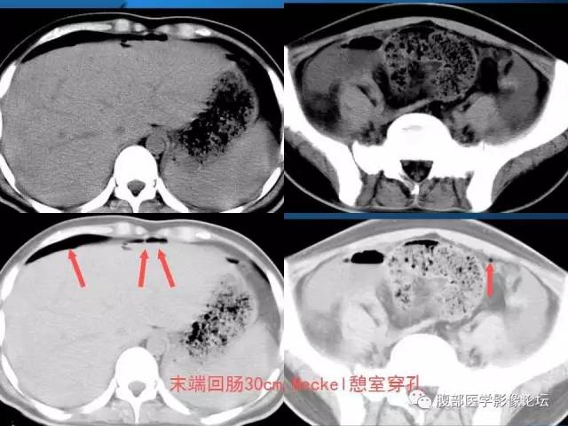 【PPT】 急腹症时的腹腔积气与积液