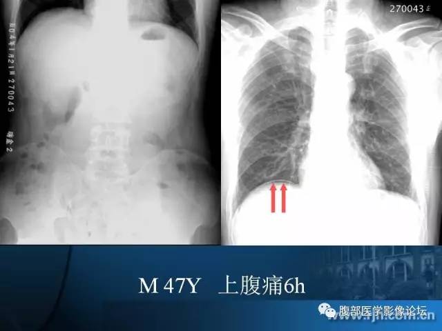 【PPT】 急腹症时的腹腔积气与积液