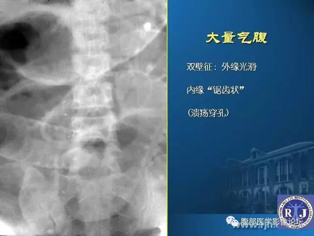 【PPT】 急腹症时的腹腔积气与积液