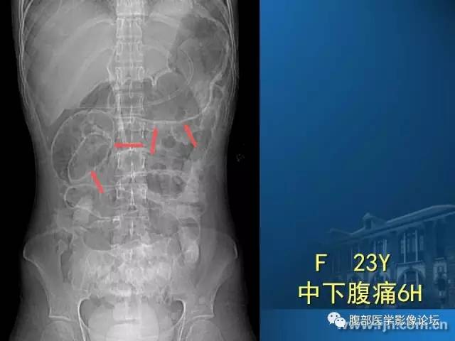 【PPT】 急腹症时的腹腔积气与积液