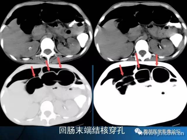 【PPT】 急腹症时的腹腔积气与积液