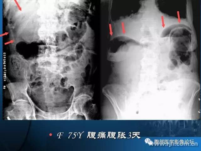 【PPT】 急腹症时的腹腔积气与积液