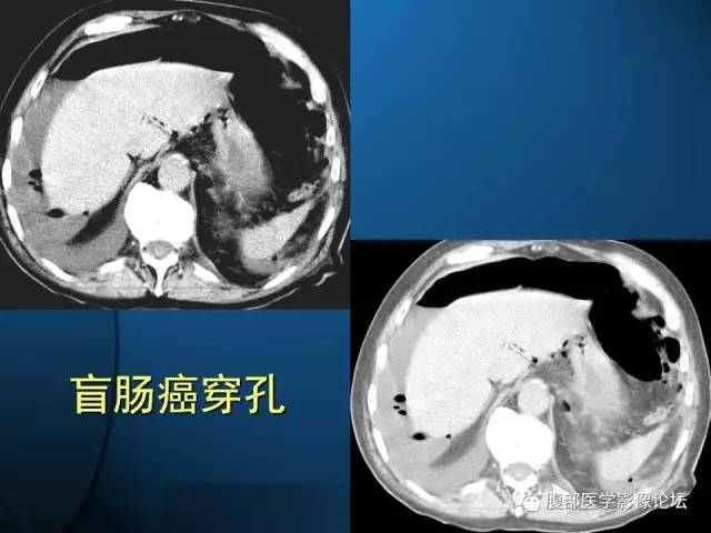 【PPT】 急腹症时的腹腔积气与积液