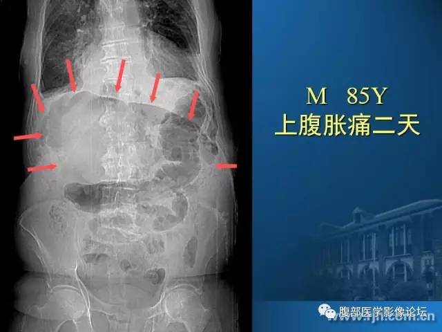 【PPT】 急腹症时的腹腔积气与积液