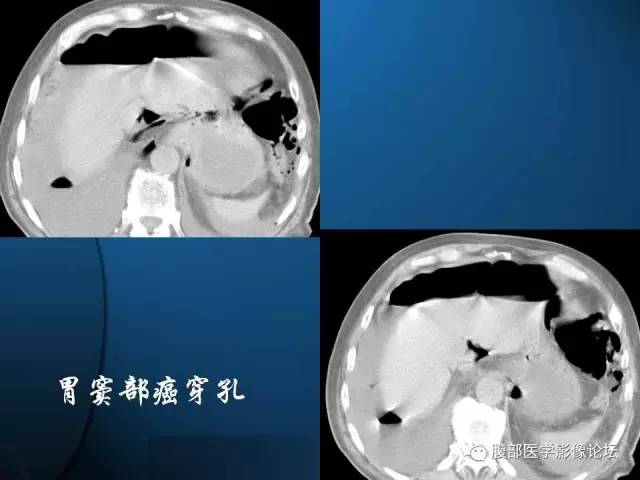 【PPT】 急腹症时的腹腔积气与积液