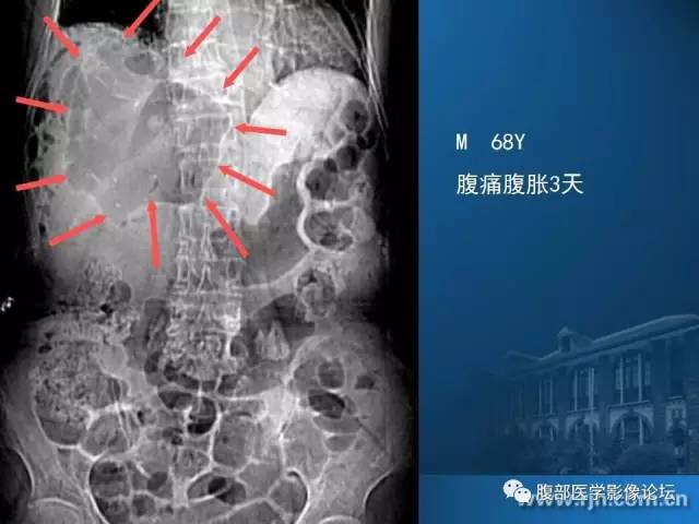 【PPT】 急腹症时的腹腔积气与积液
