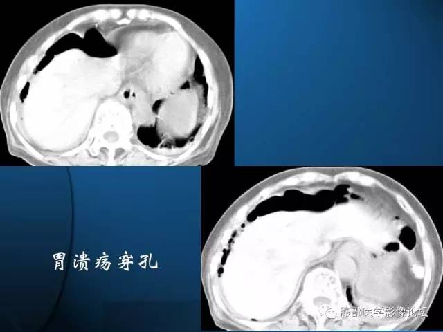 【PPT】 急腹症时的腹腔积气与积液