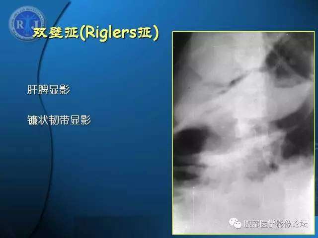 【PPT】 急腹症时的腹腔积气与积液