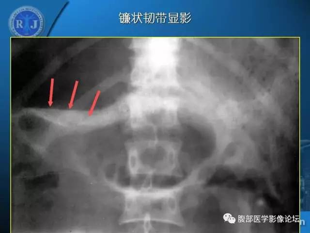 【PPT】 急腹症时的腹腔积气与积液