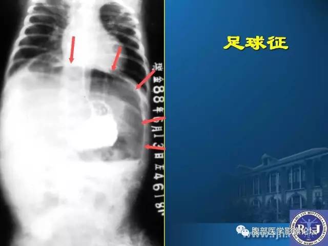 【PPT】 急腹症时的腹腔积气与积液