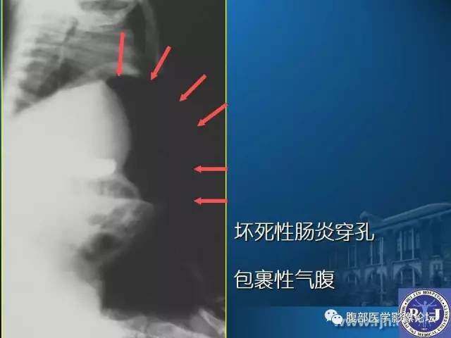 【PPT】 急腹症时的腹腔积气与积液