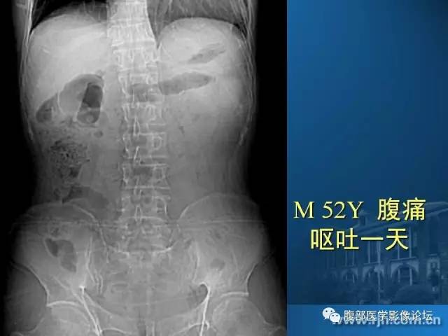 【PPT】 急腹症时的腹腔积气与积液