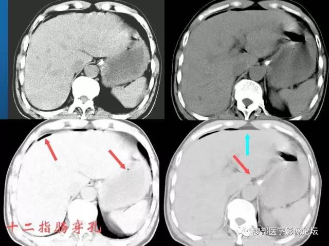 【PPT】 急腹症时的腹腔积气与积液