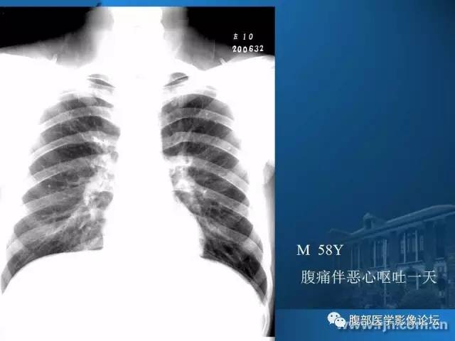 【PPT】 急腹症时的腹腔积气与积液