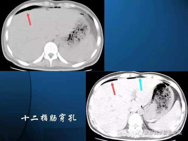【PPT】 急腹症时的腹腔积气与积液