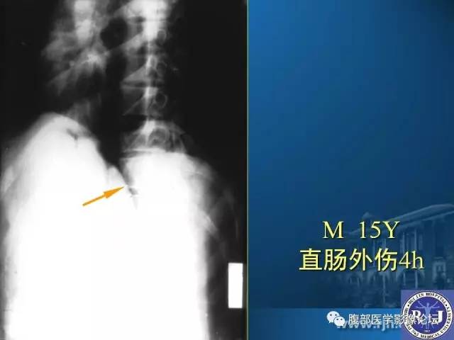 【PPT】 急腹症时的腹腔积气与积液
