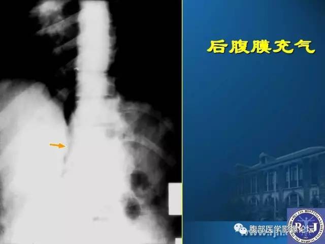 【PPT】 急腹症时的腹腔积气与积液