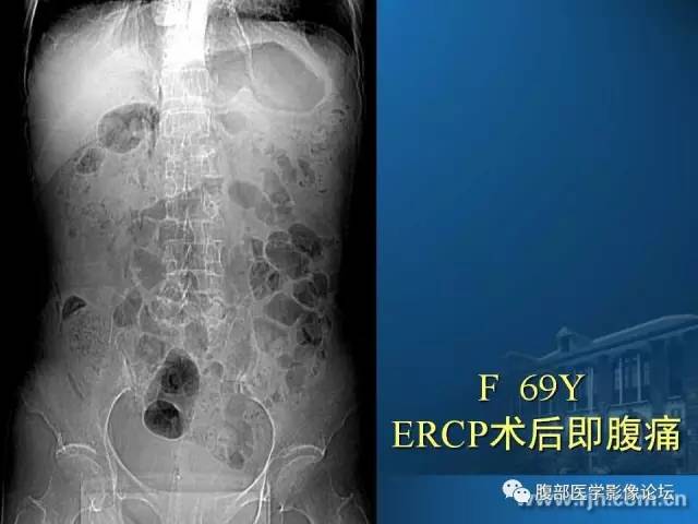 【PPT】 急腹症时的腹腔积气与积液