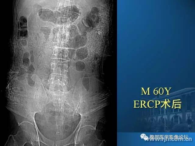 【PPT】 急腹症时的腹腔积气与积液