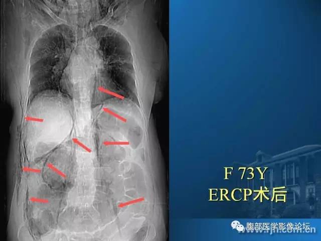 【PPT】 急腹症时的腹腔积气与积液