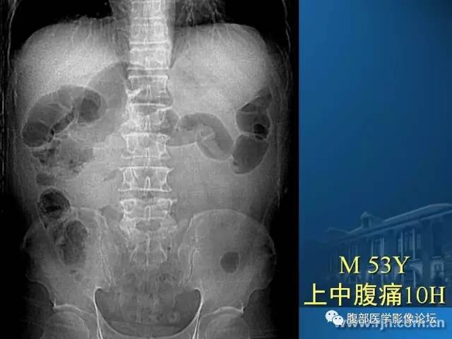 【PPT】 急腹症时的腹腔积气与积液