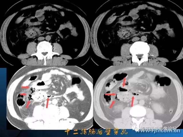 【PPT】 急腹症时的腹腔积气与积液