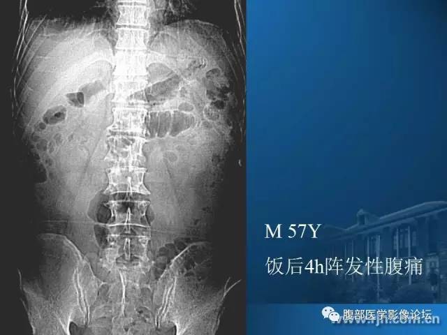 【PPT】 急腹症时的腹腔积气与积液