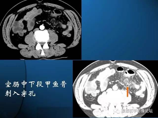 【PPT】 急腹症时的腹腔积气与积液