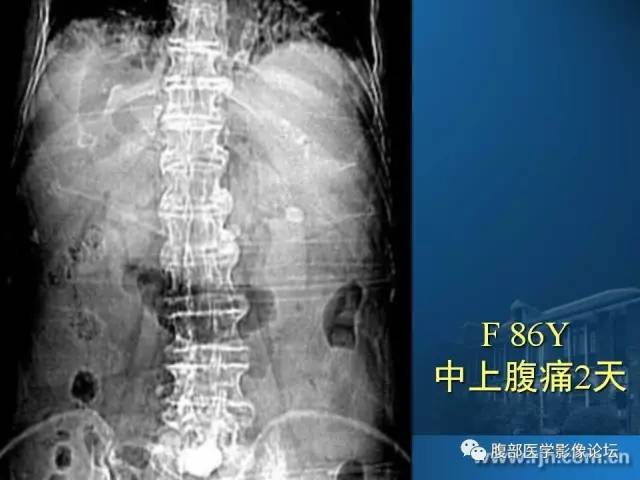 【PPT】 急腹症时的腹腔积气与积液