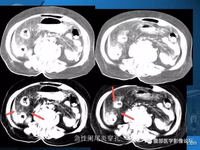 【PPT】 急腹症时的腹腔积气与积液