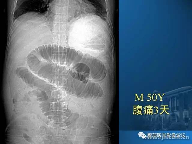 【PPT】 急腹症时的腹腔积气与积液