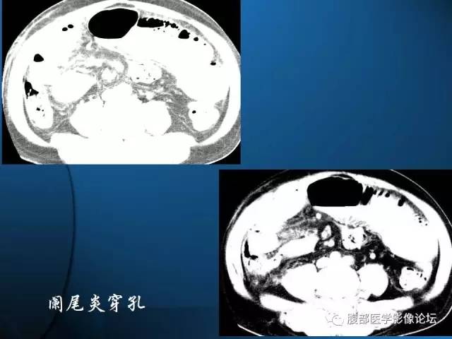 【PPT】 急腹症时的腹腔积气与积液