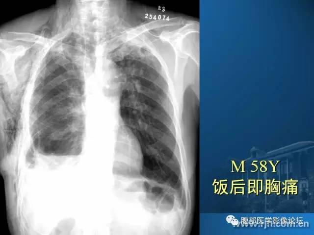 【PPT】 急腹症时的腹腔积气与积液