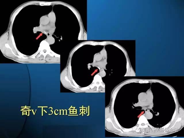 【PPT】 急腹症时的腹腔积气与积液