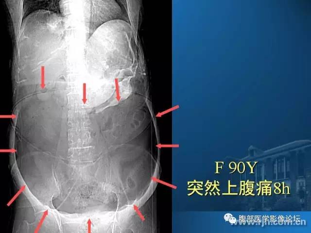 【PPT】 急腹症时的腹腔积气与积液