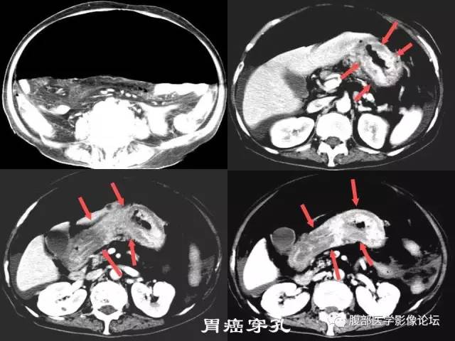【PPT】 急腹症时的腹腔积气与积液