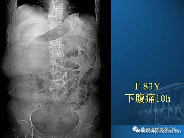 【PPT】 急腹症时的腹腔积气与积液