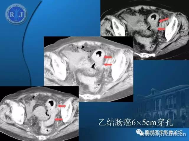 【PPT】 急腹症时的腹腔积气与积液