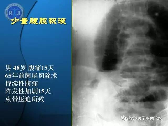 【PPT】 急腹症时的腹腔积气与积液