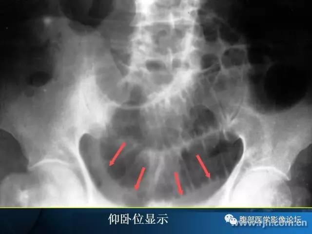 【PPT】 急腹症时的腹腔积气与积液