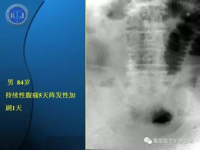 【PPT】 急腹症时的腹腔积气与积液
