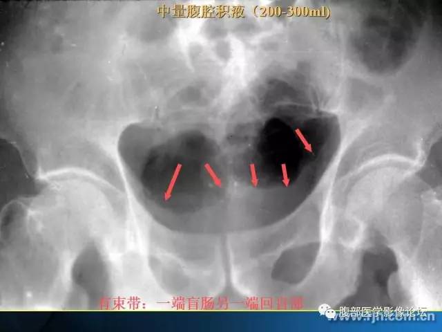 【PPT】 急腹症时的腹腔积气与积液