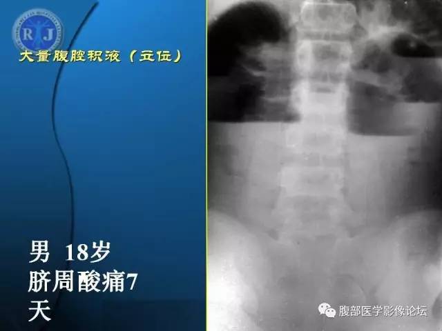 【PPT】 急腹症时的腹腔积气与积液