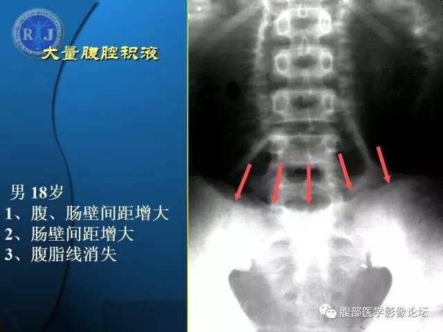 【PPT】 急腹症时的腹腔积气与积液