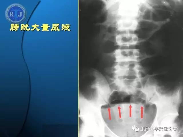 【PPT】 急腹症时的腹腔积气与积液