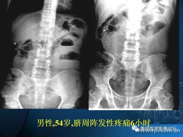 【PPT】 急腹症时的腹腔积气与积液