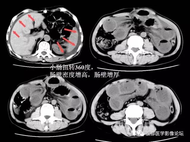 【PPT】 急腹症时的腹腔积气与积液