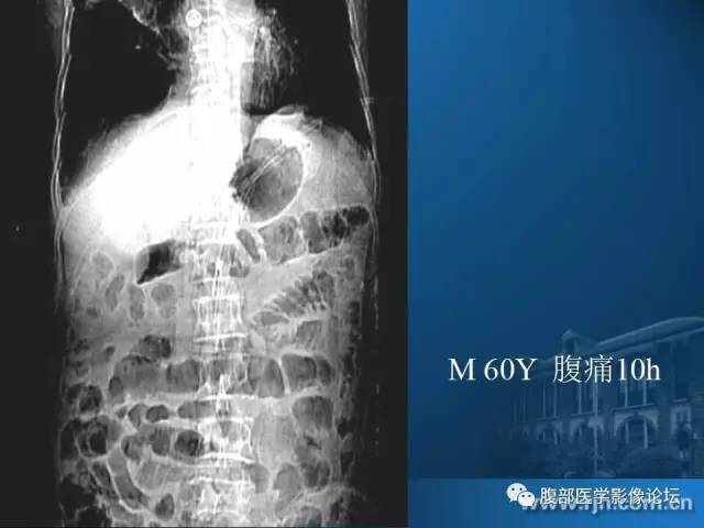 【PPT】 急腹症时的腹腔积气与积液